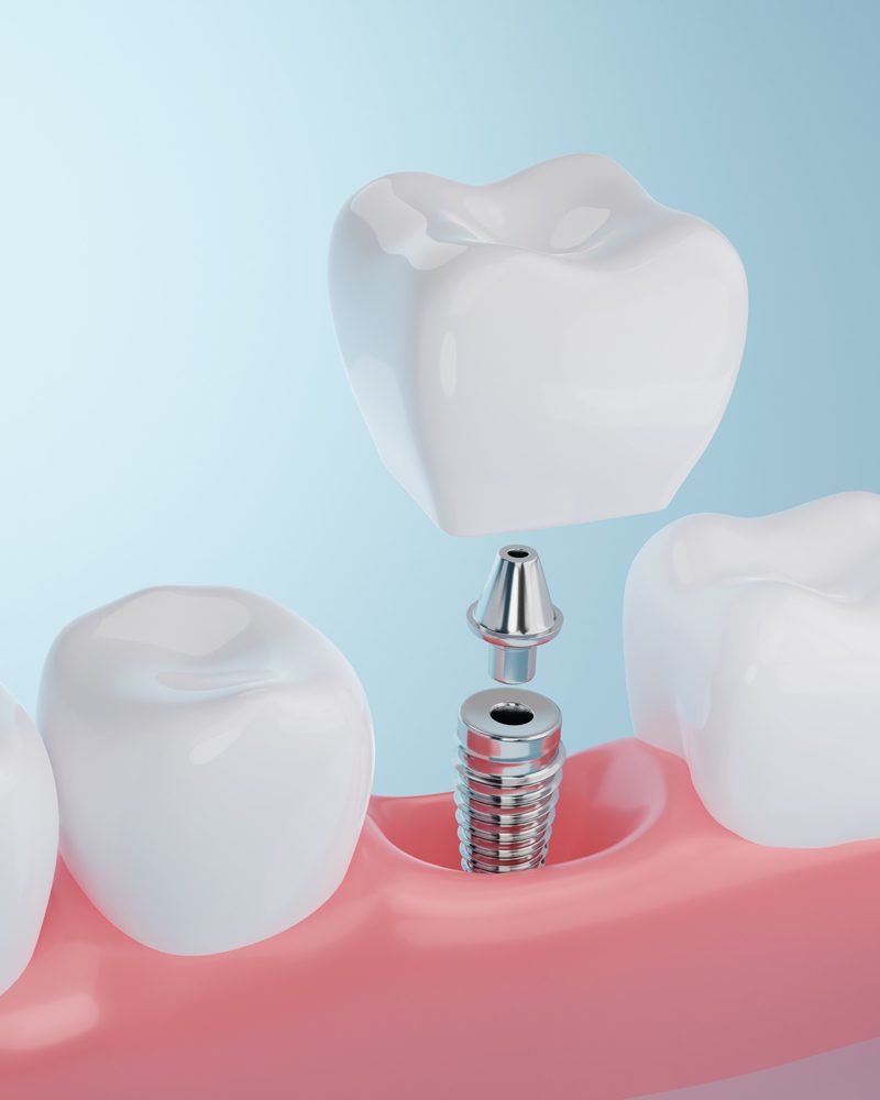 Dental Implants offered in Nashville, TN by Embassy Dental