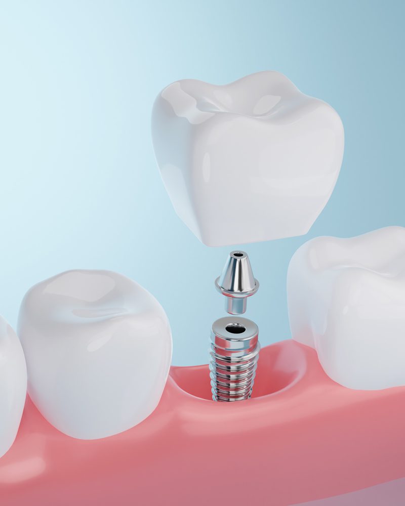 Dental Implants Brentwood, TN